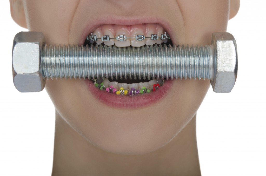 Teeth with braces  compressed metal screw