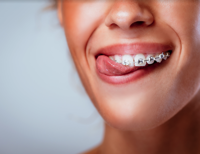 Advance Metal Braces Vs Ceramic Clear Braces